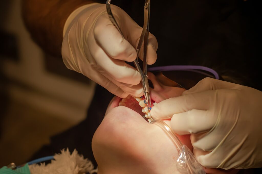Orthodontist put on metal braces. Orthodontic treatment. Bonding braces